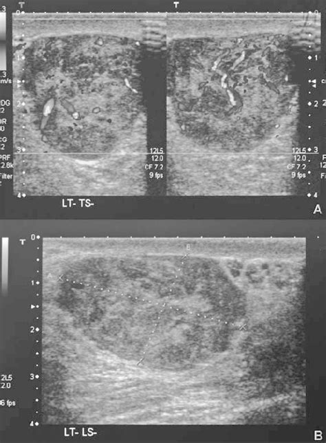 A Is A Scrotal Ultrasound Showing A Well Circumscribed Lesion Of Mixed