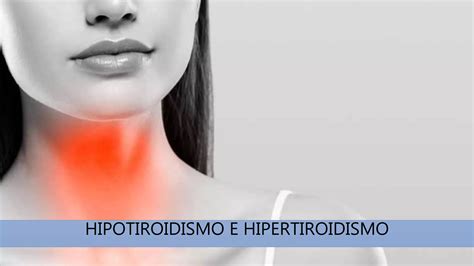 Hipotiroidismo E Hipertiroidismo Proped Utica M Dica Ppt