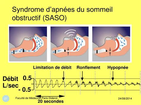 PPT Le Syndrome dApnées du Sommeil PowerPoint Presentation free