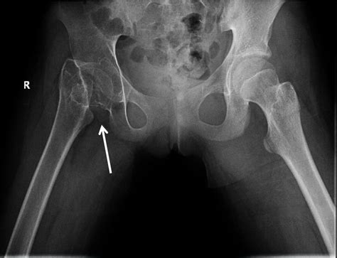 Peds Femoral Neck Frature. Frog XRay. Annotated. JETem 2020 - JETem