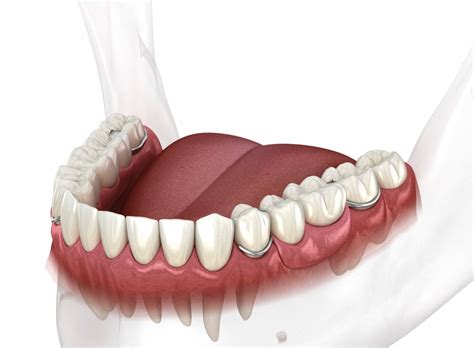 partial denture | Lakeshore Dental