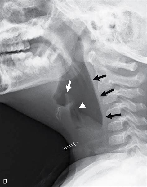 Croup X Ray