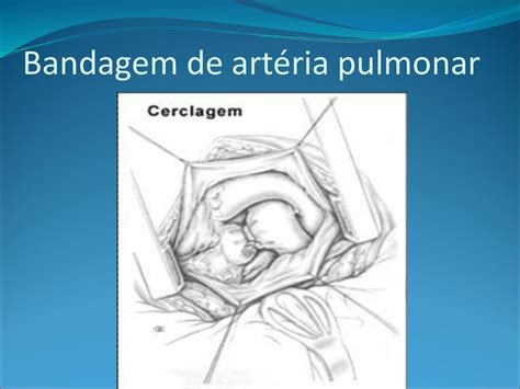 Caso Clinico Atresia Tric Spide Ppt Carregar