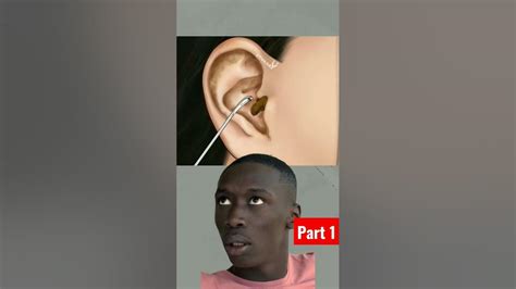 Roach In Ear Part One Youtubeshorts Earinfection Youtube