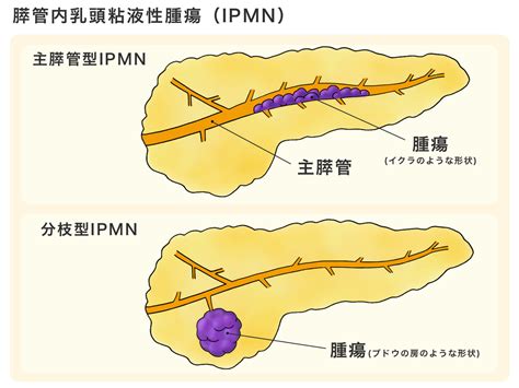 医師監修・作成 膵臓がん以外の膵臓の病気：膵炎、ipmnなどについて Medleyメドレー