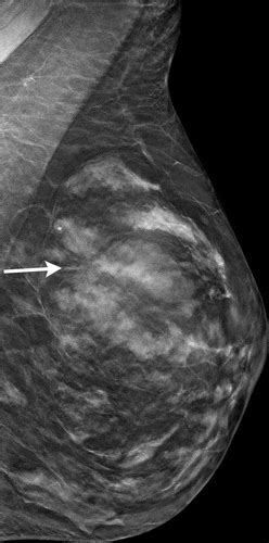 Breast Cancer Screening With Digital Breast Tomosynthesis Are Initial