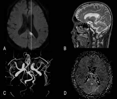 Axial Diffusion Weighted Magnetic Resonance Imaging MRI Demonstrated