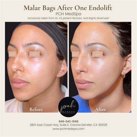 Endolift Before After Pch Medspa