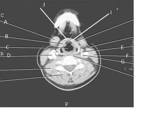 Head Ct Diagram Quizlet