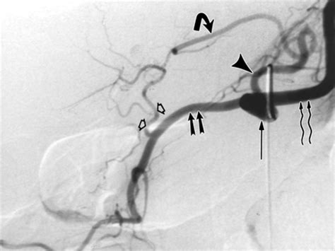 The Pump And The Tubes Middle Hepatic Artery