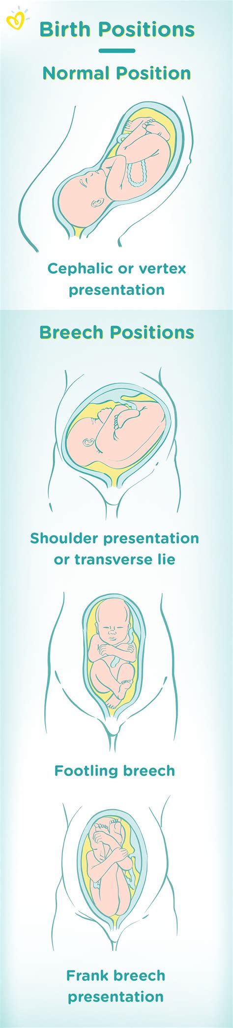 Vertex Position Fetal Position In