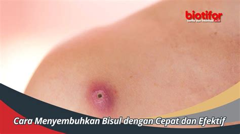 Cara Menyembuhkan Bisul Dengan Cepat Dan Efektif Biotifor