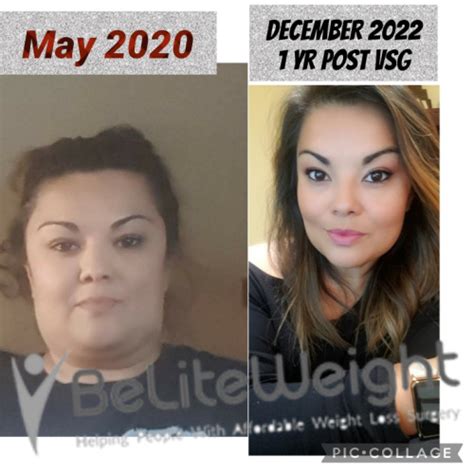 Gastric Sleeve Before And After Beliteweight Weight Loss Services