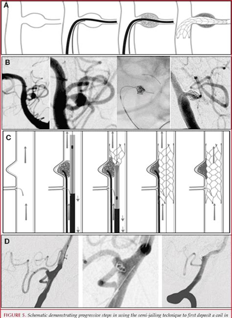 Figure 4 From Semi‐jailing Technique For Coil Embolization Of Complex