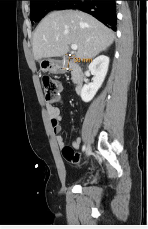 Figure From Incidental Finding Of A Fish Bone Perforation In The