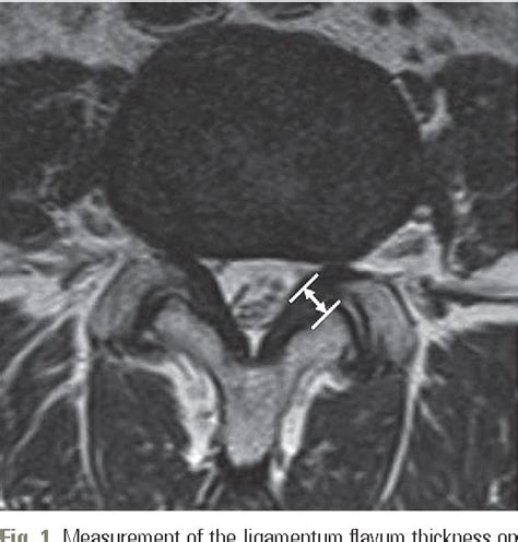 Figure 1 From Analysis Of The Relationship Between Hypertrophy Of The Ligamentum Flavum And