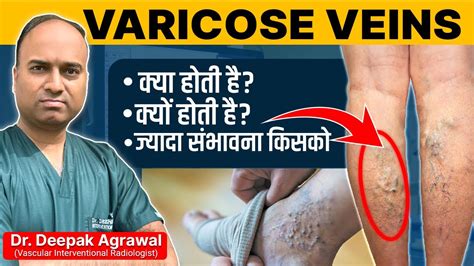 Varicose Veins क्या क्यों और कैसे होती हैं किसको ये होने की संभावना