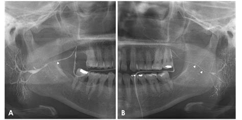 Parotid Gland Inflammation