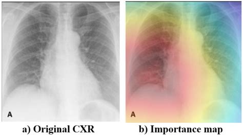 The CXR image indicates the infected areas with pneumonia. | Download Scientific Diagram