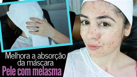 V Deo Pr Tico E Explicativo Uma Das Melhores M Scaras P Melasma