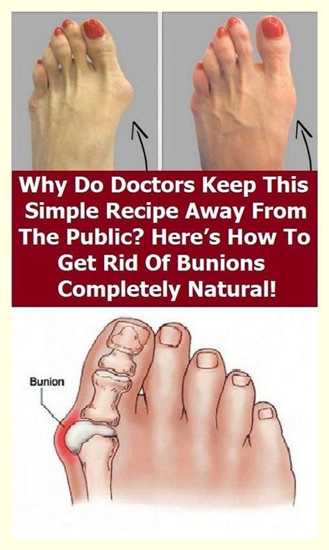 Get Rid Of Bunions Artofit