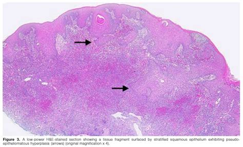 Granulomatosis With Polyangiitis An Oral Medicine Case Book