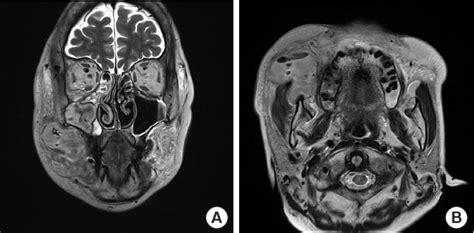 Figure 1 From Surgical Approach To Necrotizing Fasciitis In The Buccal