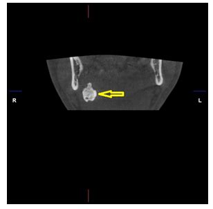 CBCT Imaging Of A Giant Sialolith Megalith