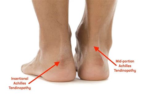 How To Manage Achilles Tendinopathy — Oregon Running Clinic