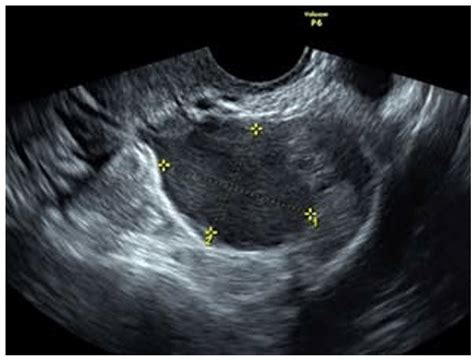 A Typical Ultrasound Image Of An Endometriosis Cyst In The Ovary Is