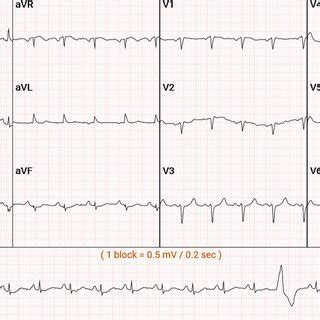 EKG On Admission EKG Showed The Patient To Be In Sinus Tachycardia