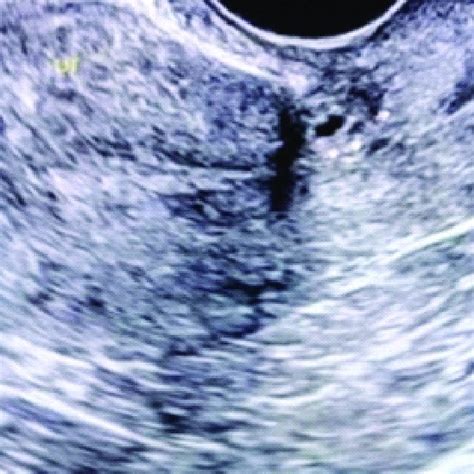 Transvaginal Sonography Tvs Image Of Caesarean Scar Pregnancy