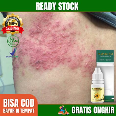 Promo Obat Kulit Cacar Air, Cacar Ular, Herpes Simpleks, Scabies Manusia - Jakarta Timur ...