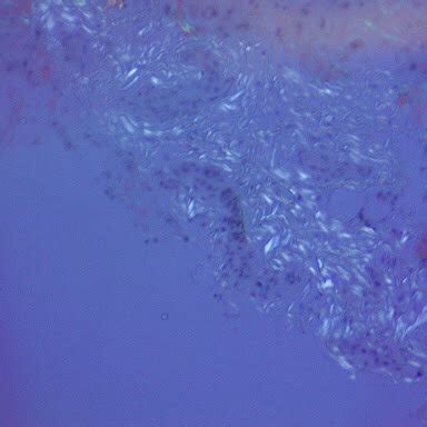 Liver Biopsy Demonstrating Staining Of Amyloid A Protein Deposition