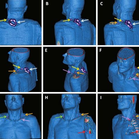 Schematic Representation Of The Sentinel Lymph Node Sln Concept