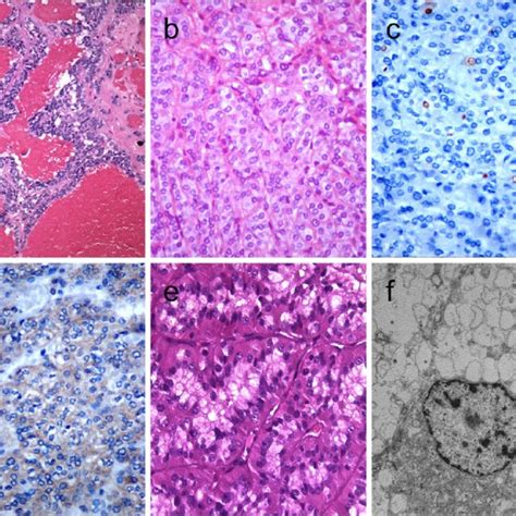 Columnar Cell Variant Of Papillary Thyroid Carcinoma Ptc Showing A