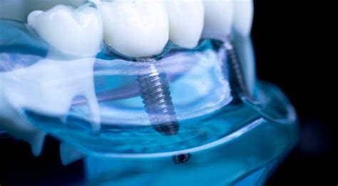 What Are The Alternatives To Dental Implants Findglob