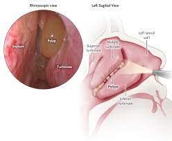 Nasal Polyps | Front Range Otolaryngology