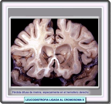 Adrenoleucodistrofia Adrenoleucodistrofia Associada Ao Cromossomo X