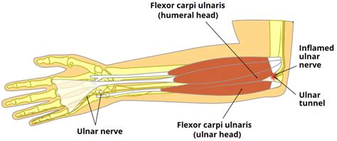 The Ulnar Tunnel - Borders - Contents - TeachMeAnatomy