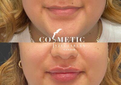 Restylane Kysse Benefits Cost Reviews Sherman Oaks