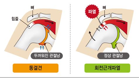 ‘어깨 통증 참지 맙시다 시사저널