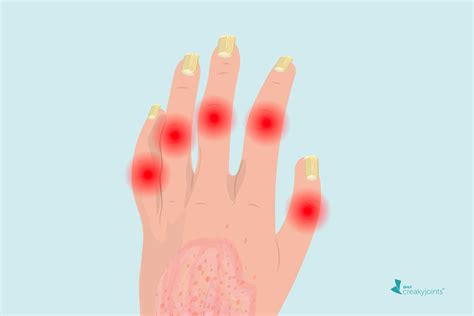 People with Nail Psoriasis May Have a Higher Chance of Developing PsA