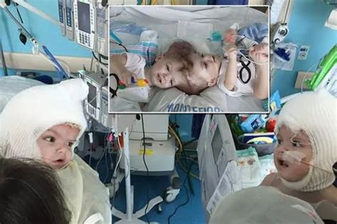 Heartwarming Moment Conjoined Twins Connected At Head Finally See Each Other After Life