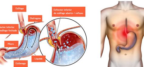 Doença do refluxo gastroesofágico DRGE Clínica do Aparelho