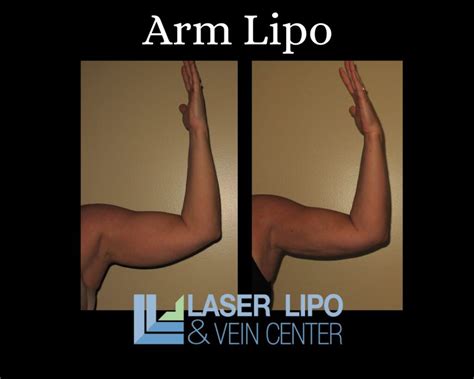 Arm Liposuction St. Louis | Laser Lipo and Vein Center