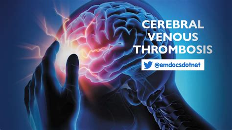 Cerebral Venous Thrombosis