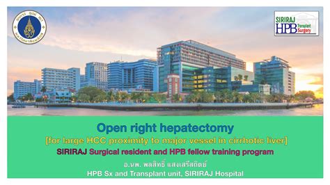 How I Do It Open Right Hepatectomy For Large Hcc Proximity To Major