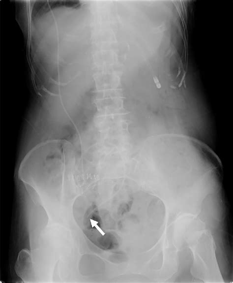 Figure 1 From Supradiaphragmatic Intrathoracic Migration Of