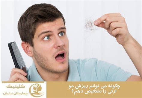 جدیدترین درمان ریزش موی ارثی الگوی طاسی مردانه یا ریزش موی ژنتیکی